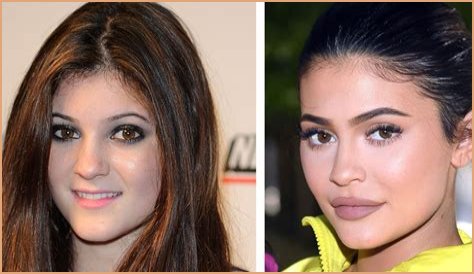 Kylie Jenner posts pic after getting all her lip filler removed